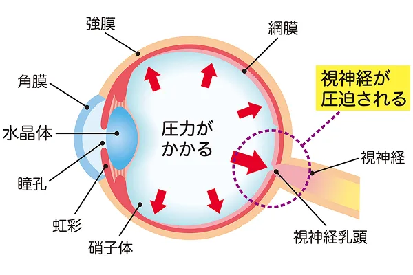 緑内障の種類と原因